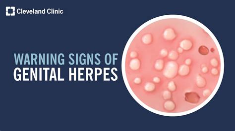 Genital Herpes Symptoms: What to Look For